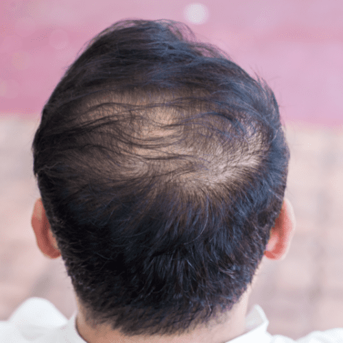 Side Effects of Hair Loss Treatments Men Ignore