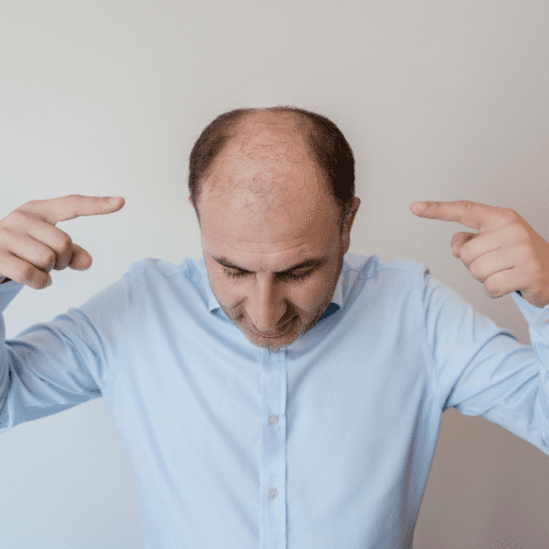 The Science Behind Male Pattern Baldness
